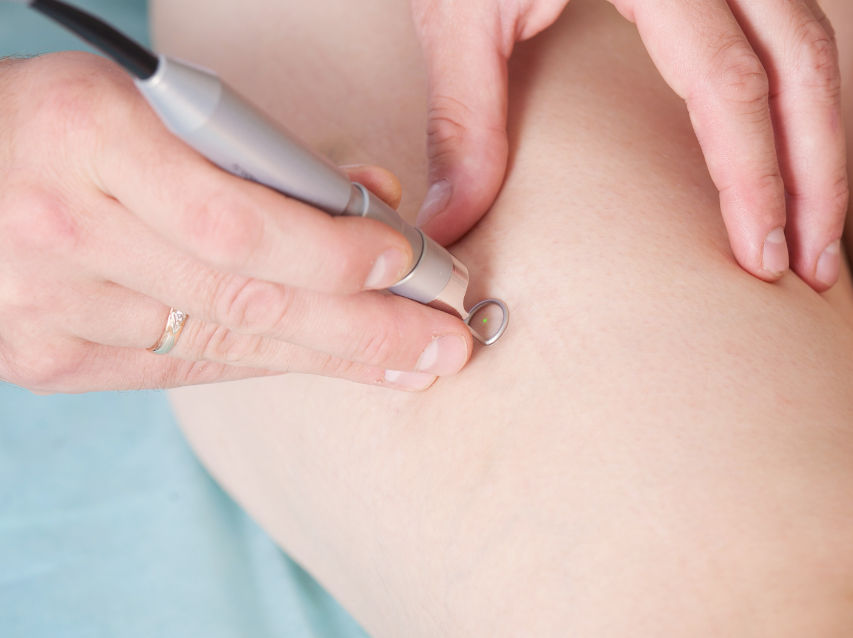 laserowe zamykanie naczynek lublin